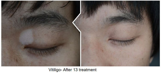 CFDA 308NM Excimer System Laser Vitiligo Machine XeCl 140s Treatment