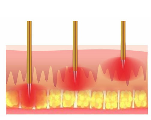 High Effective Rf Radio Frequency Skin Tightening Machine For Face Lift